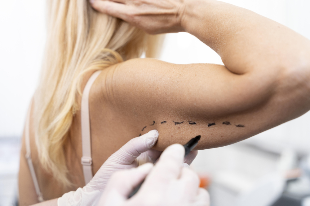 Lifting de Braços (Braquioplastia)