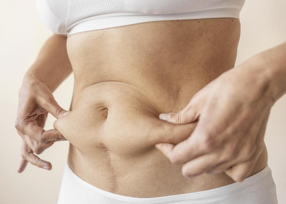 Miniabdominoplastia