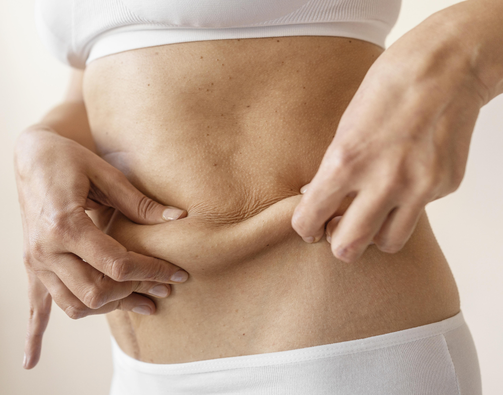 Abdominoplastia R.A.F.T.